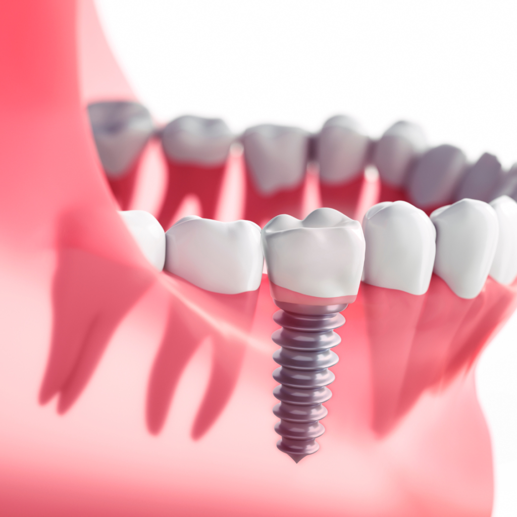 best dental implants in guwahati