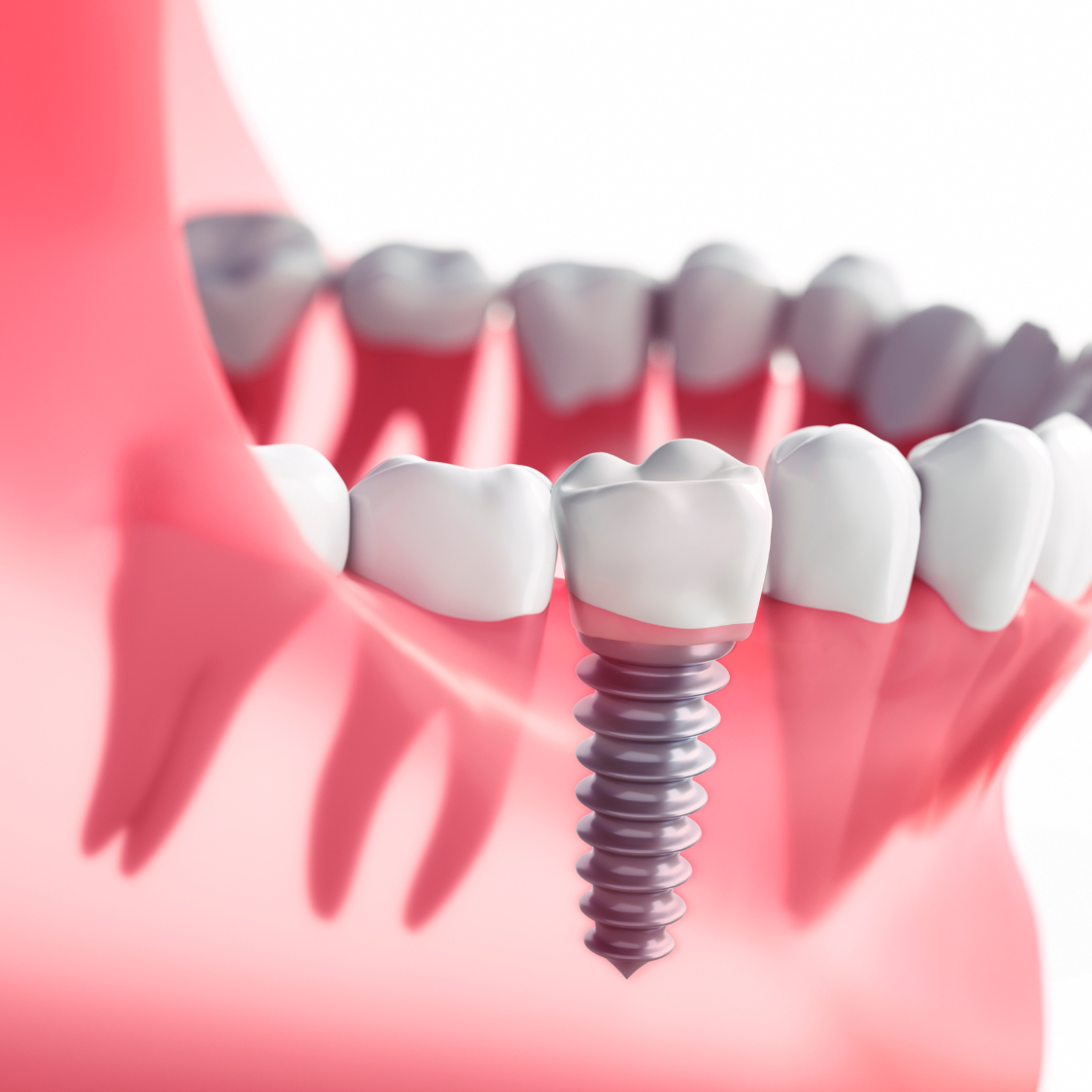 best dental implants in guwahati