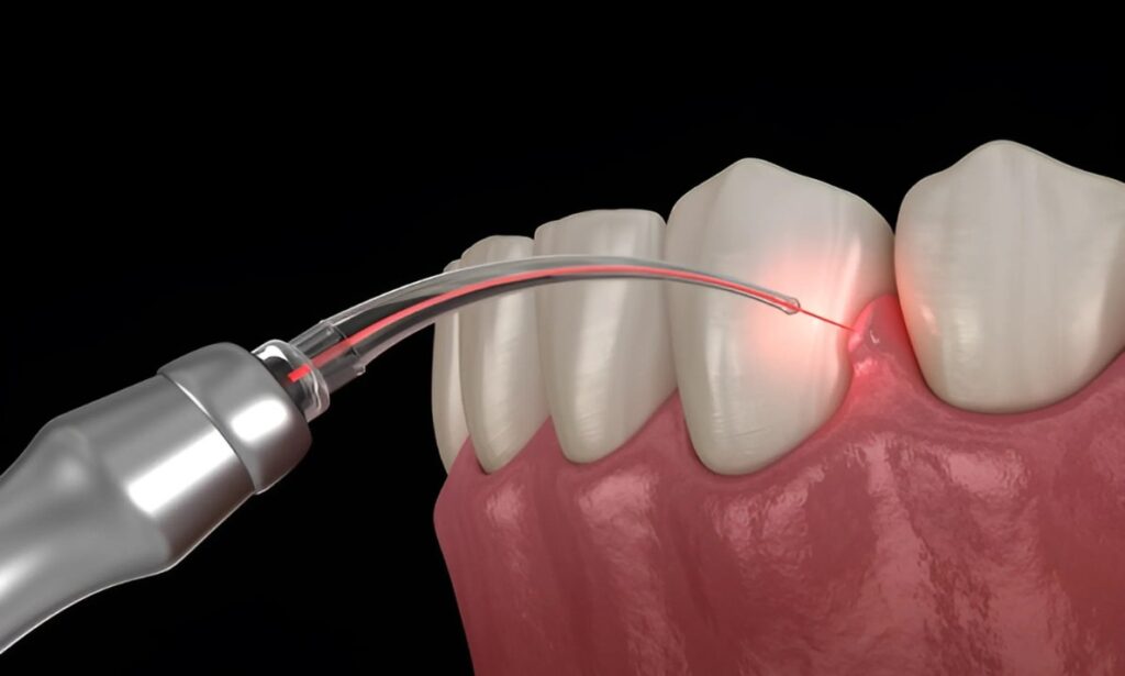 lase dental treatment in RGIMS Guwahati