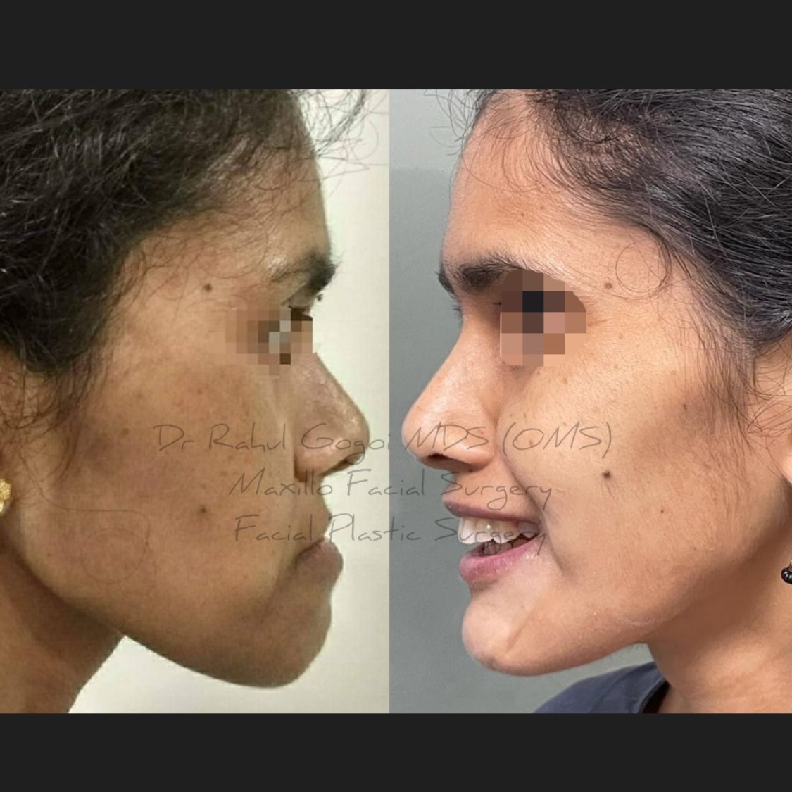 Jaw Contouring