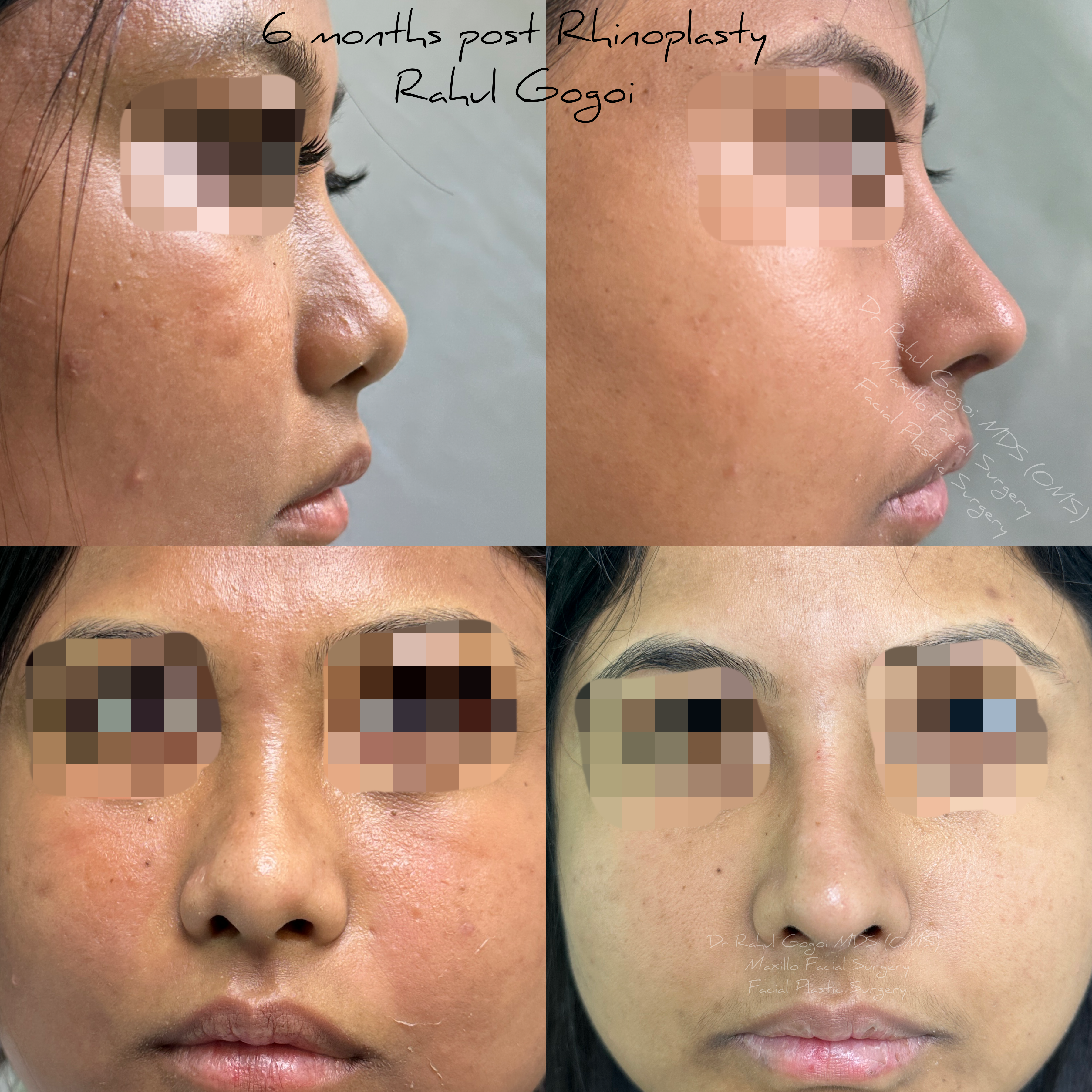 price of rhinoplasty in india