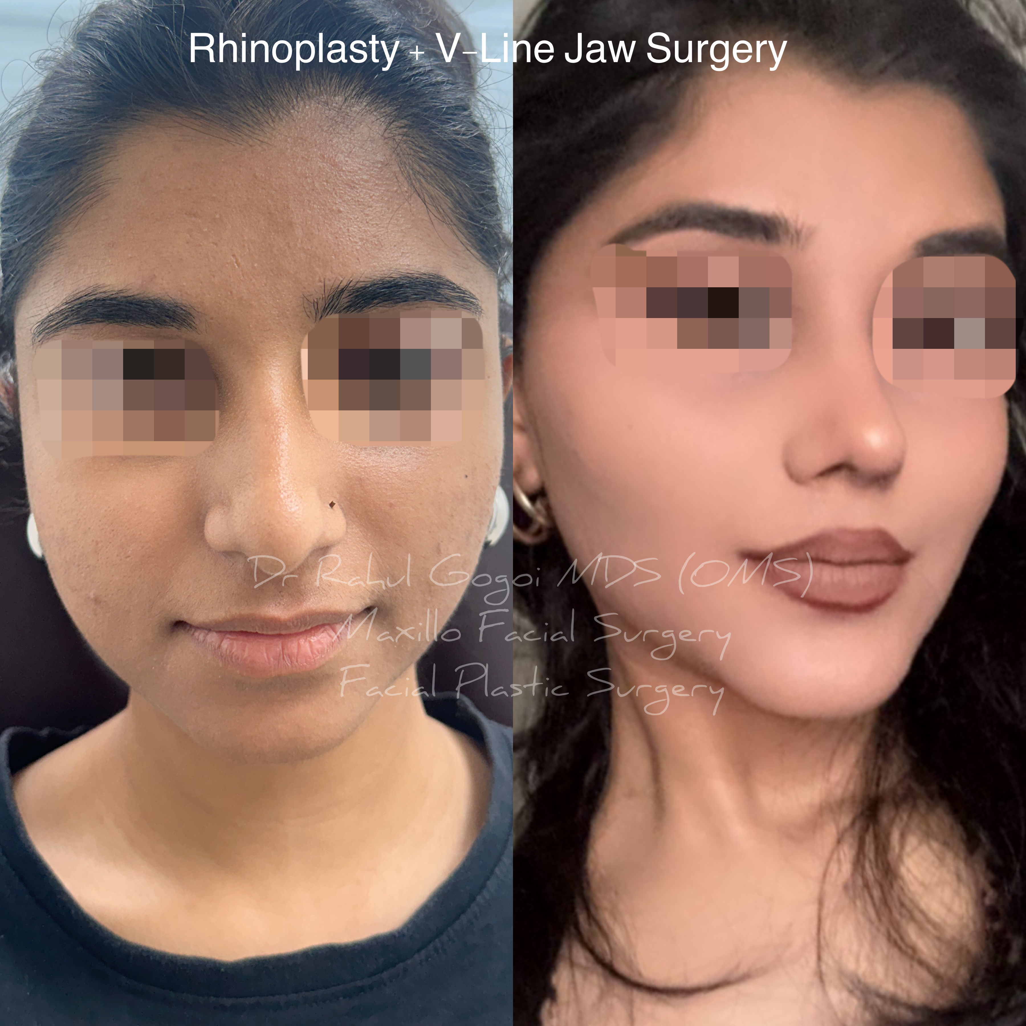 best rhinoplasty surgeon in guwahati