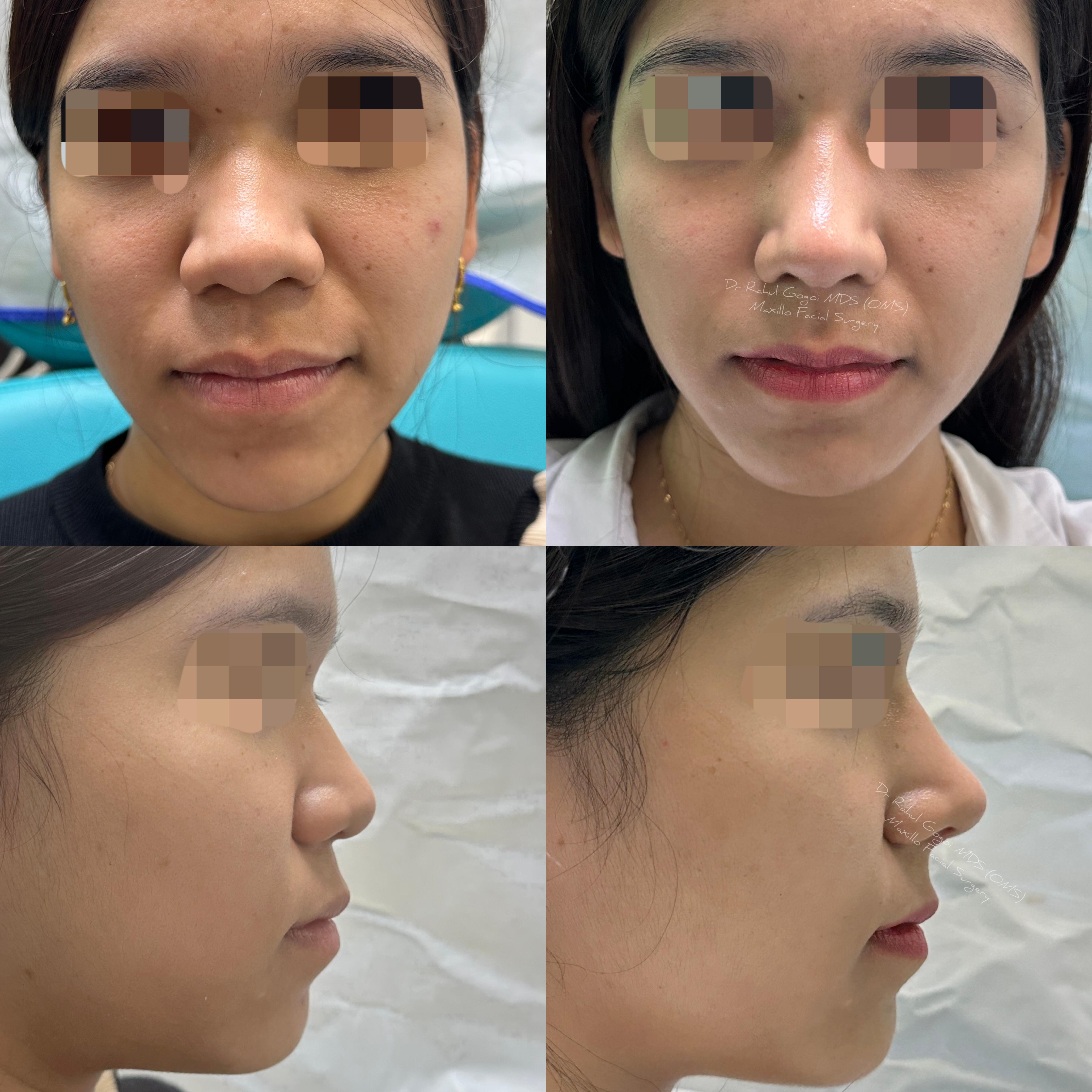 price of rhinoplasty in india