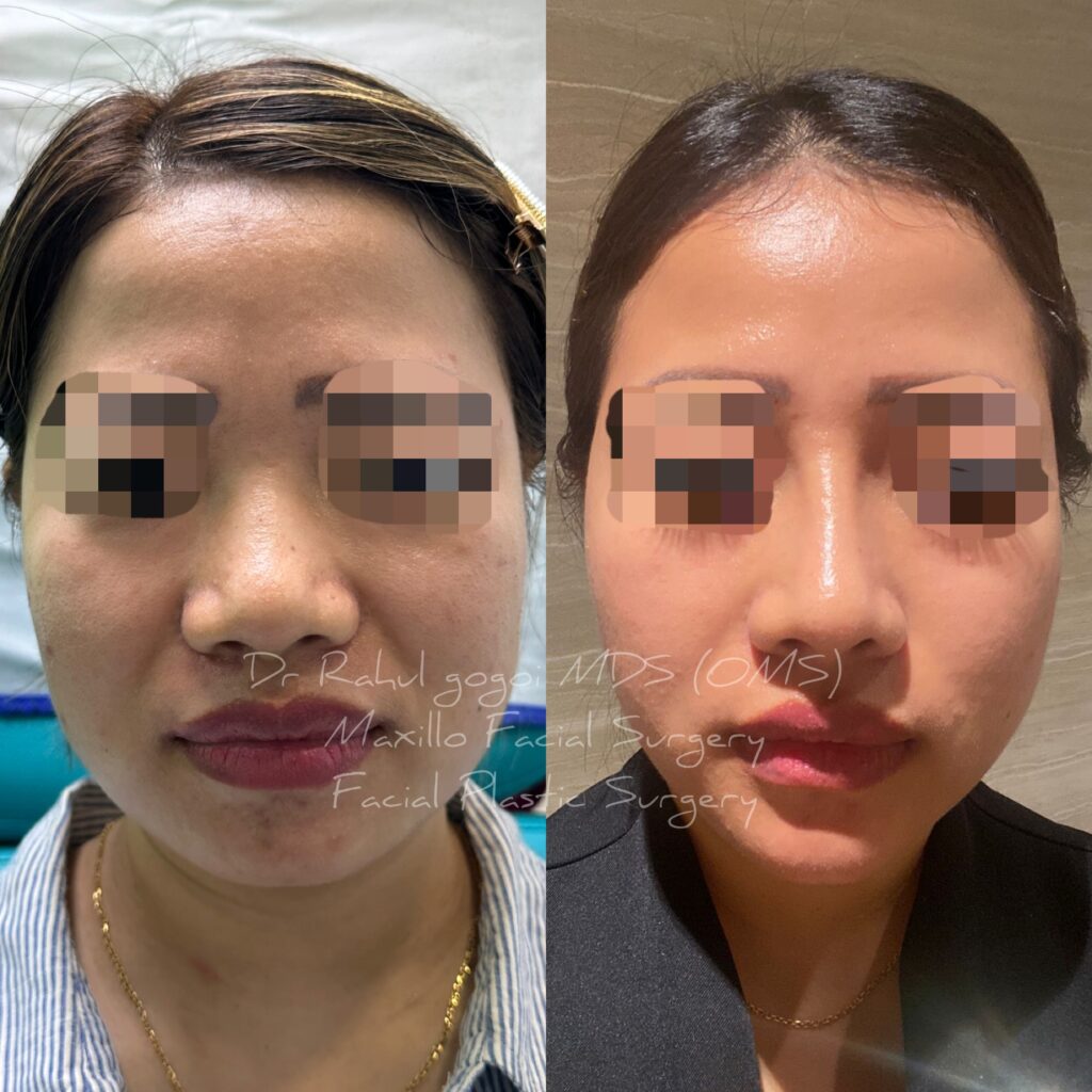 V line jaw surgery done by Dr Rahul gogoi in guwahati
