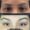 brow lift