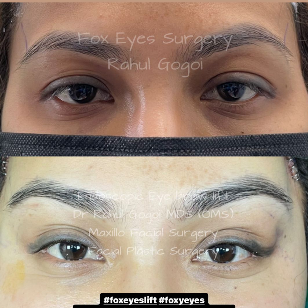 brow lift