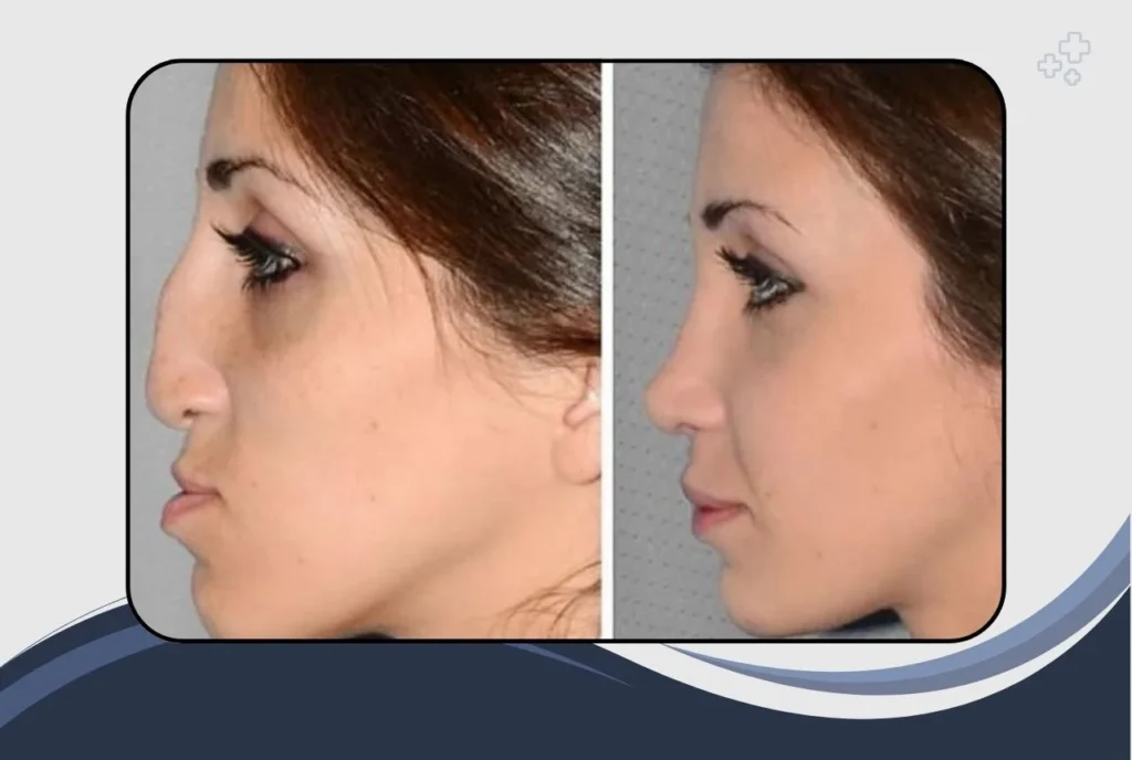 What Is Nose Surgery and Why Do People Choose It?