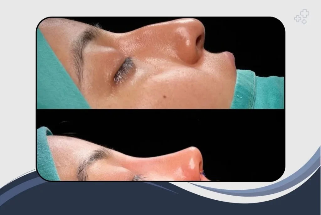 Is Nose Surgery Right for You?