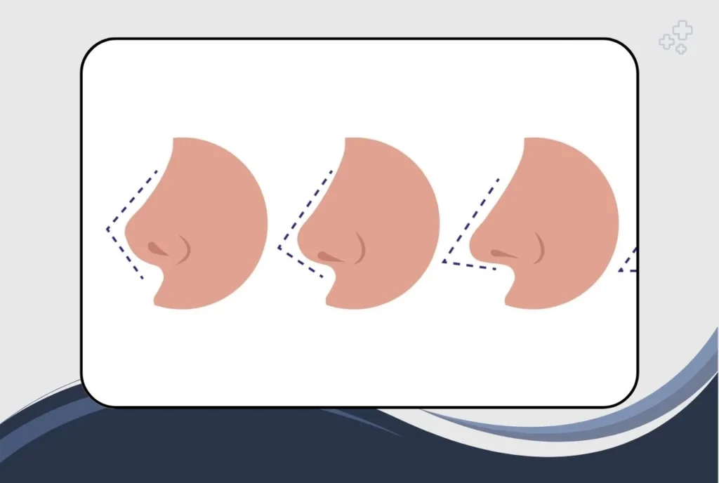 Different Types of Nose Surgery