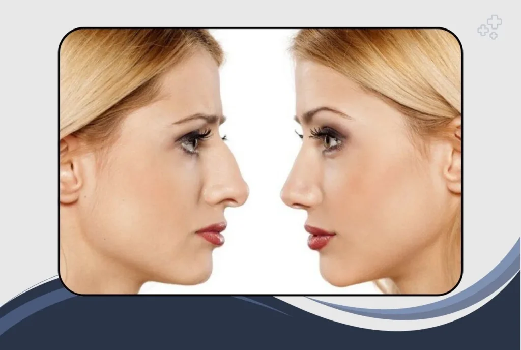 Why Nose Surgery Could Be Right for You
