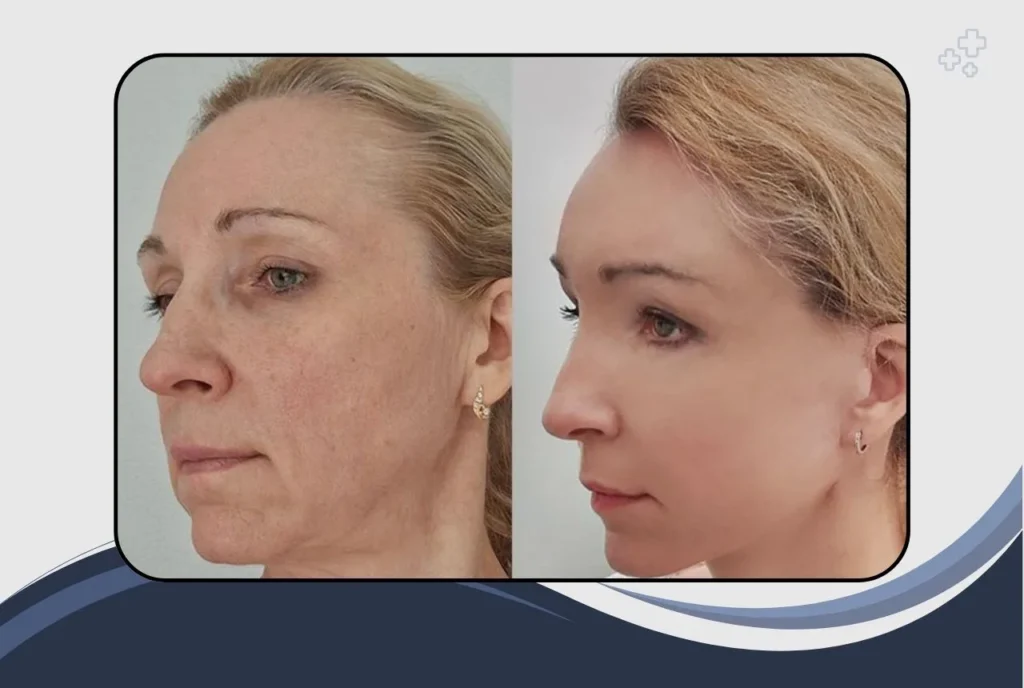 What Is a Facelift?