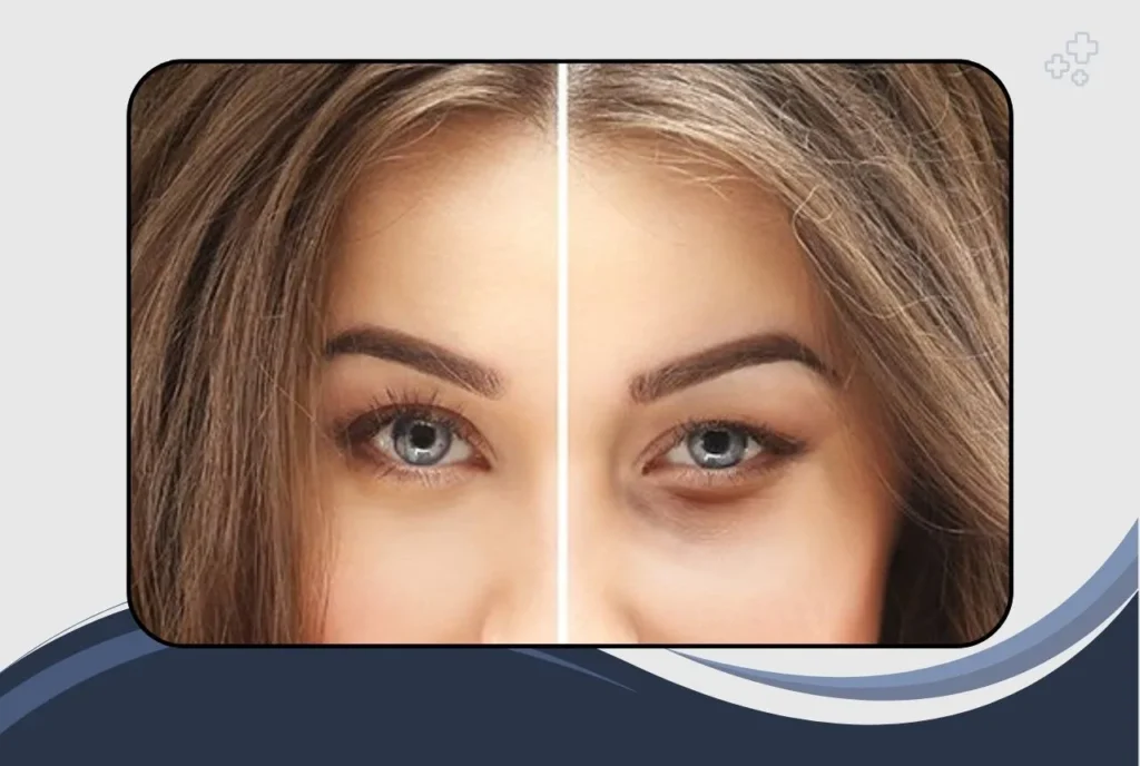 Lower Eyelid Blepharoplasty