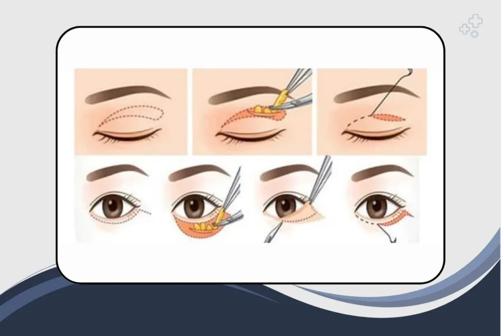 The Blepharoplasty Procedure: Step-by-Step