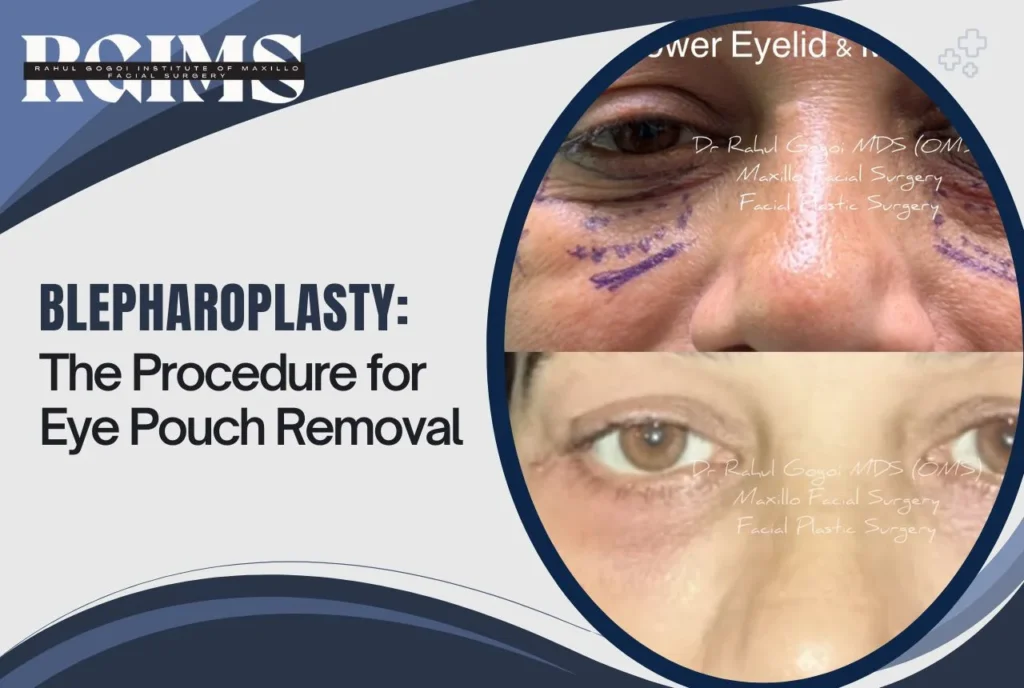 Image: Blepharoplasty