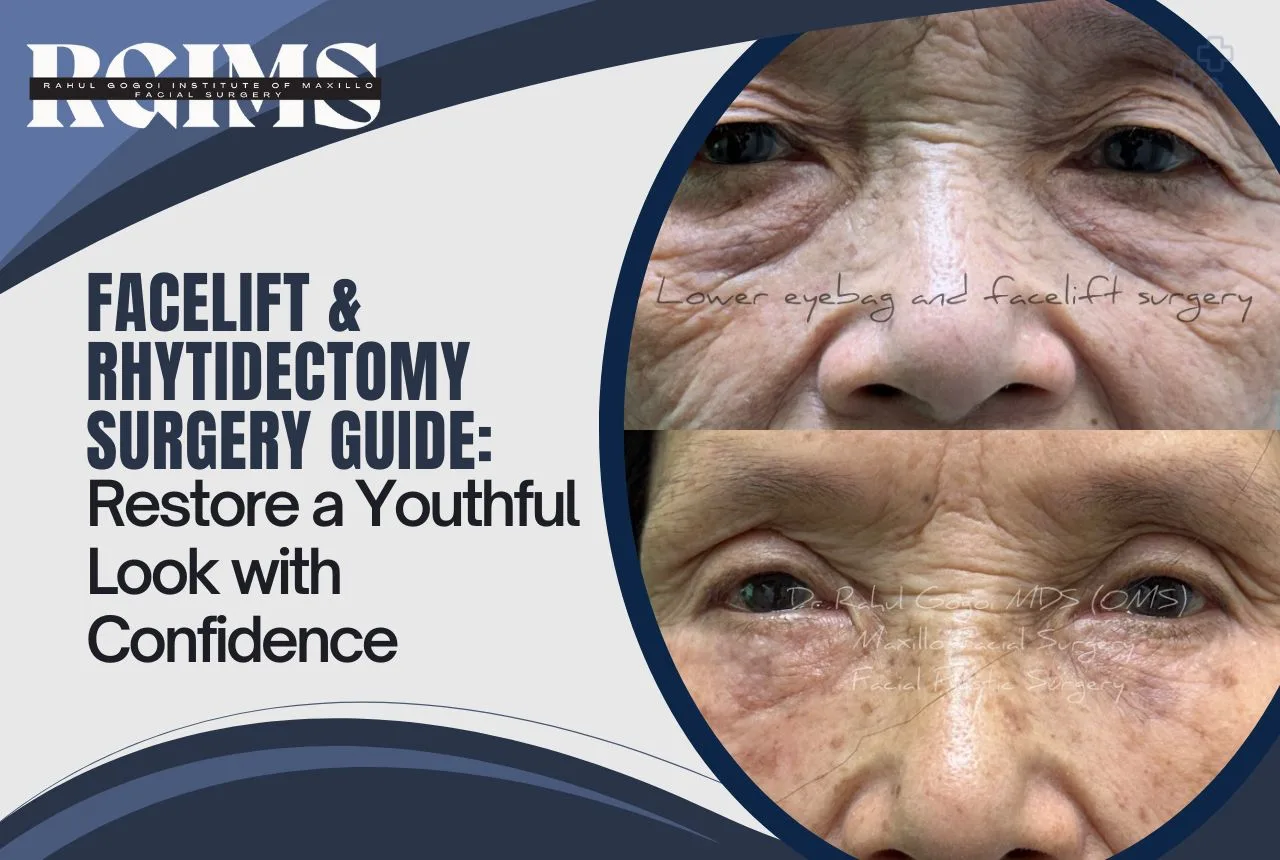 Image: Rhytidectomy Surgery