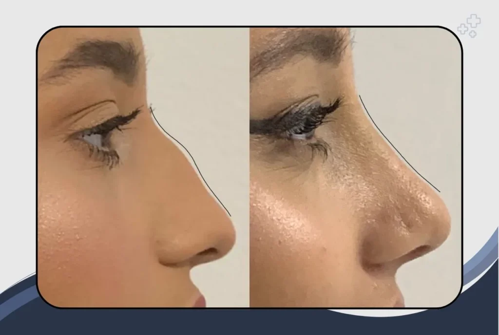 Why Nose Shape Matters More Than You Think