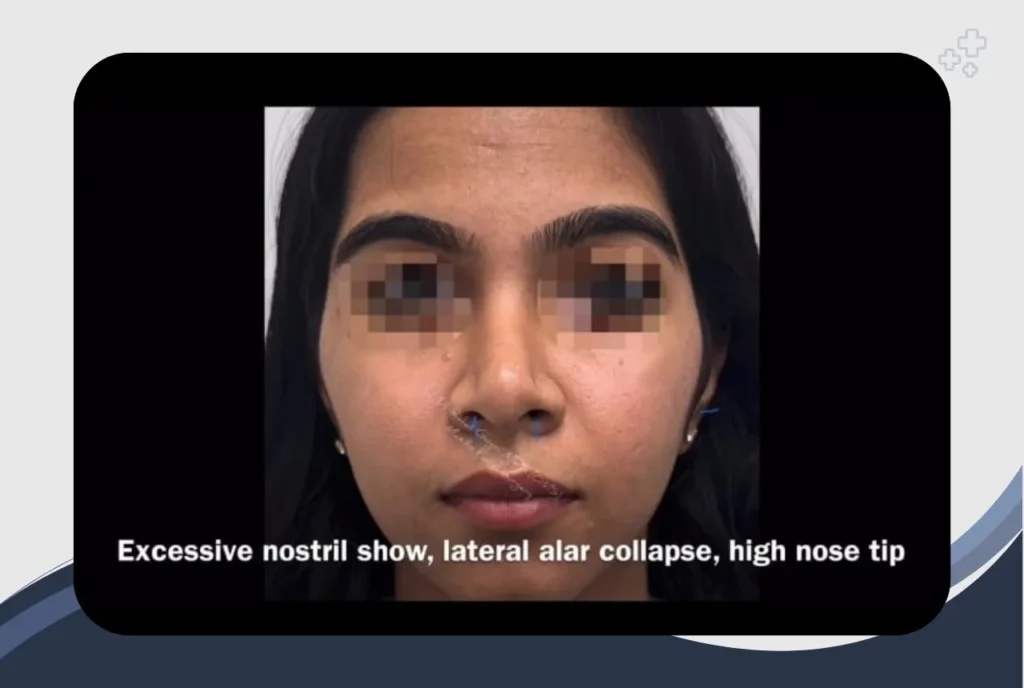 Different Types of Nose: A Guide to Nose Shape Types