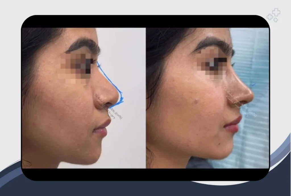 Before and After: A Case Study in Expert Rhinoplasty