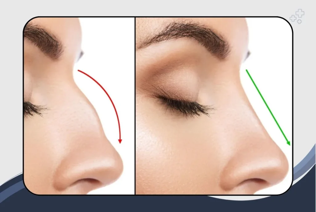 Rhinoplasty