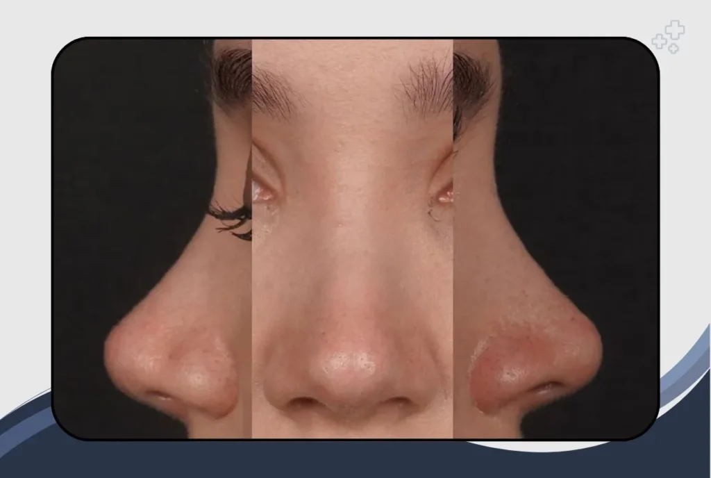 Price of Rhinoplasty in India Compared to Other Countries