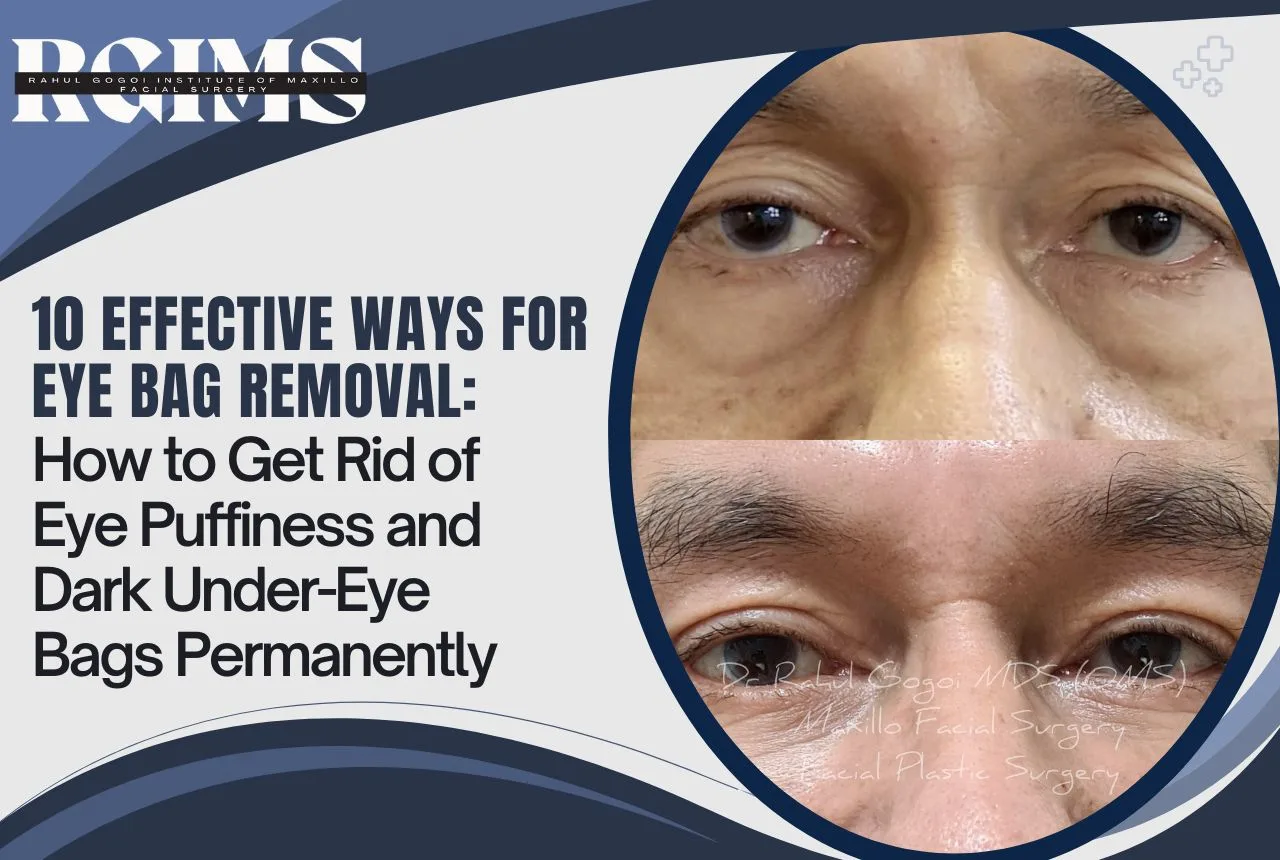 Image: Eye Bag Removal