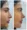 Rhinoplasty in India