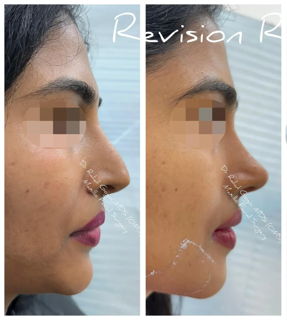 Rhinoplasty in India
