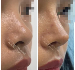 Rhinoplasty