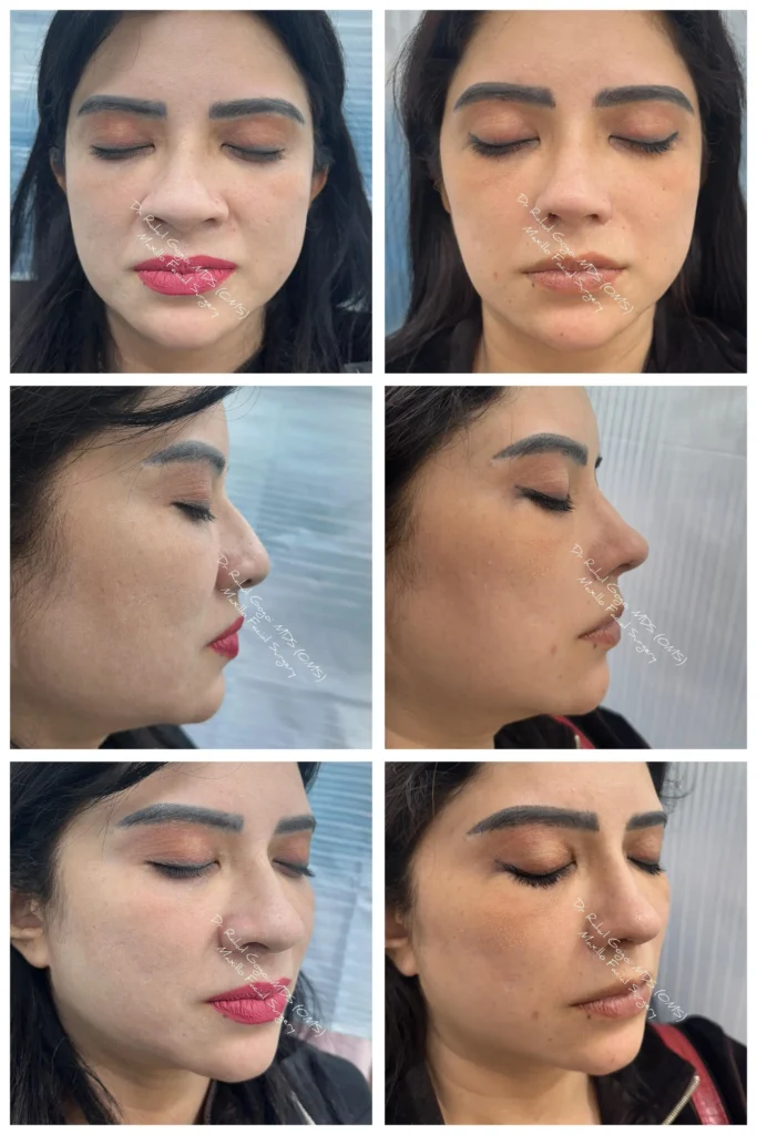 Revision Rhinoplasty Cost