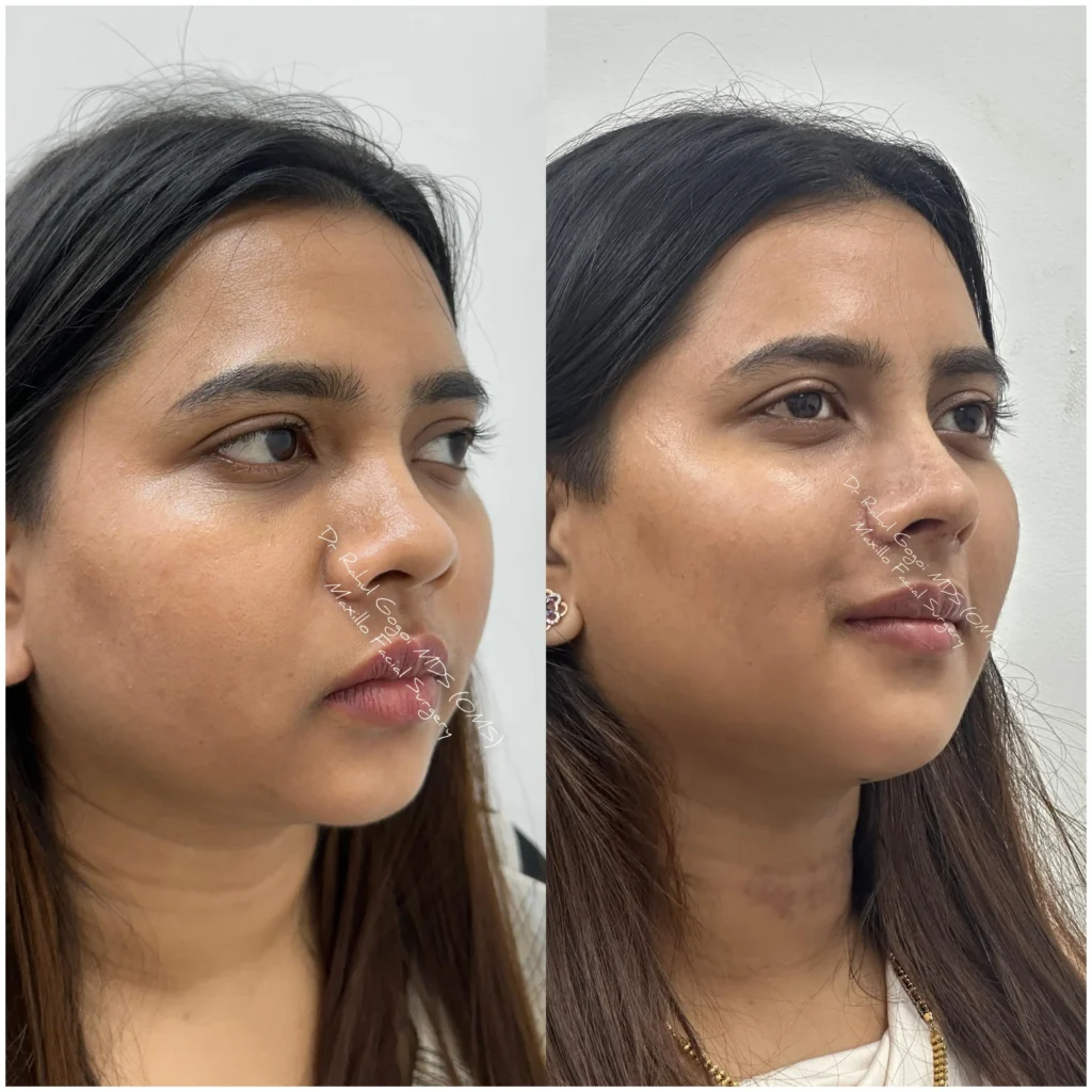 Rhinoplasty plastic Surgery