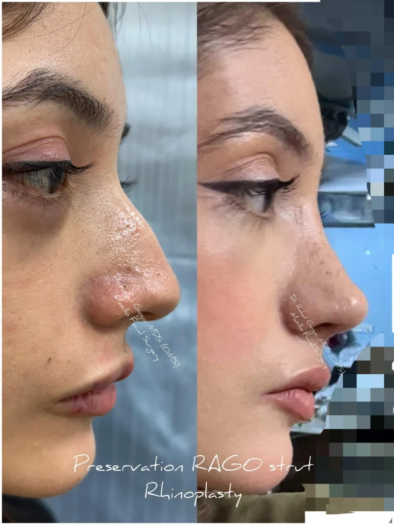 Rhinoplasty in India