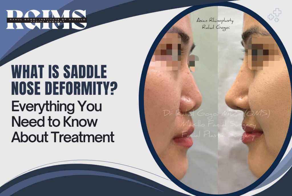 Saddle Nose Deformity