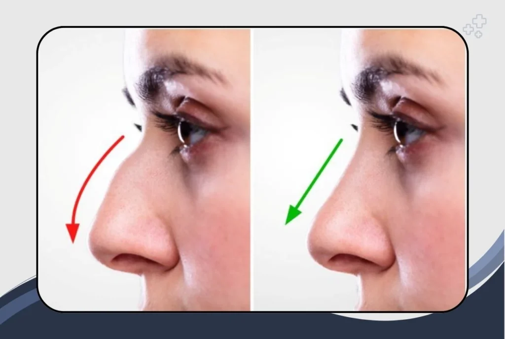 Cosmetic Rhinoplasty