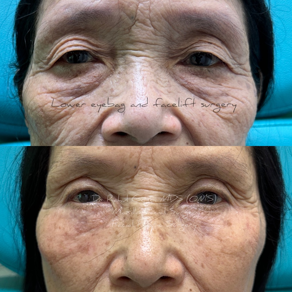 Facelift Surgery