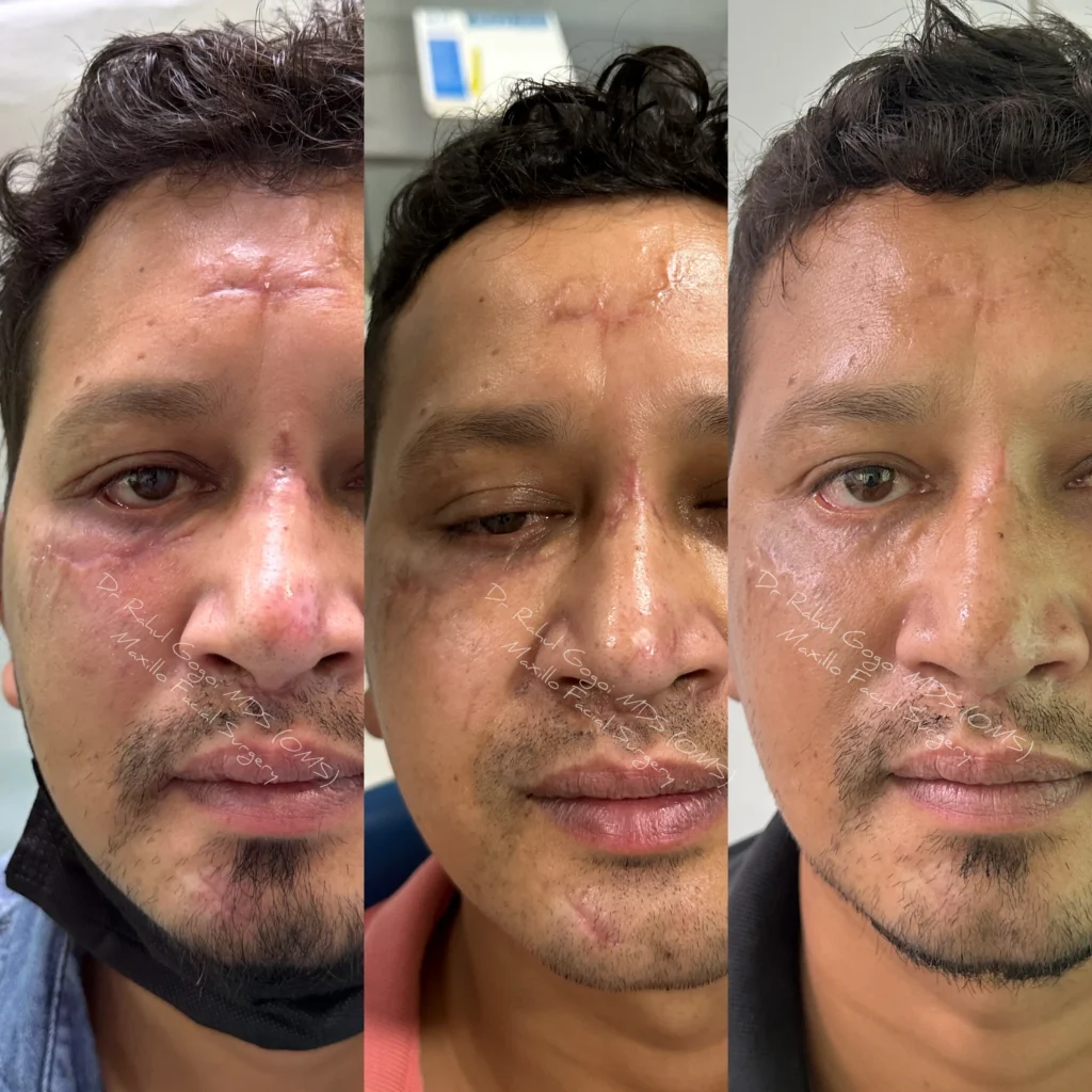 Surgical Scar Revision Cost