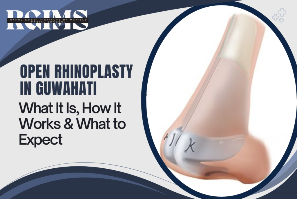 Open Rhinoplasty in Guwahati
